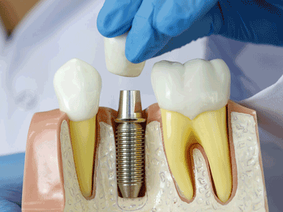 Dental Implantology