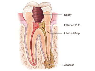 Root Canal Treatment